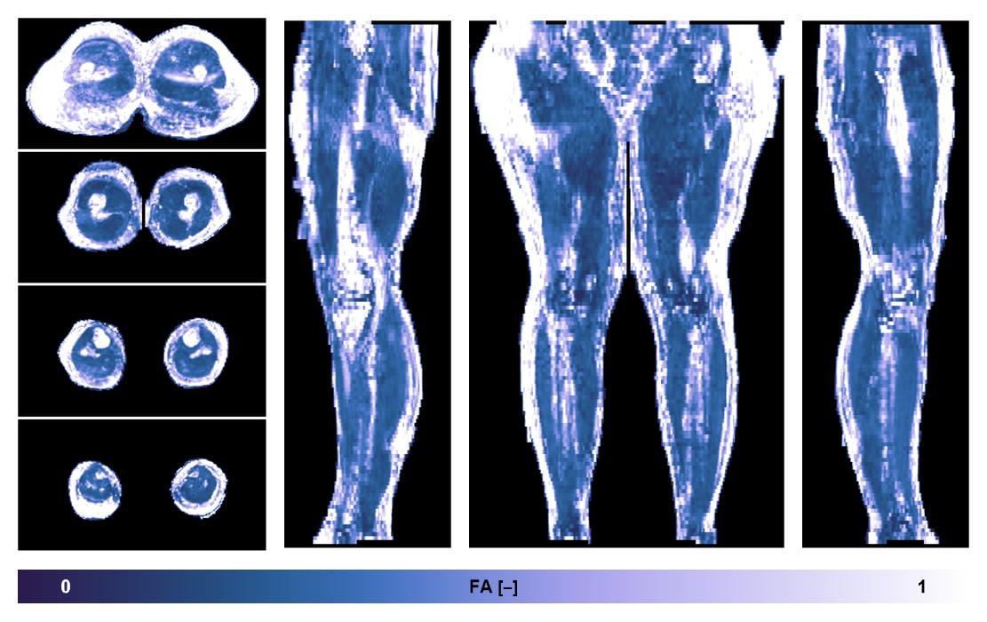 IVIM corrected whole leg muscle fractional anisotropy obtained from diffusion tensor imaging.